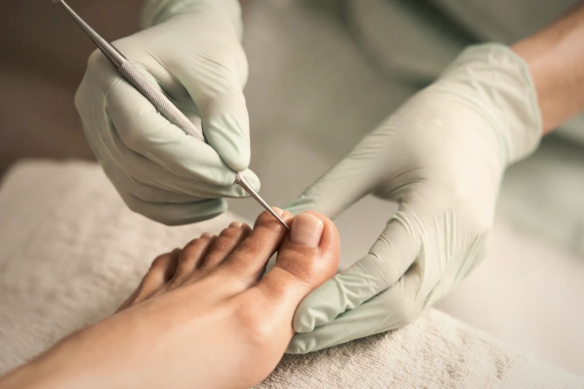 Eckenzange & seitliche Nagelbearbeitung bei eingewachsenen Nägeln